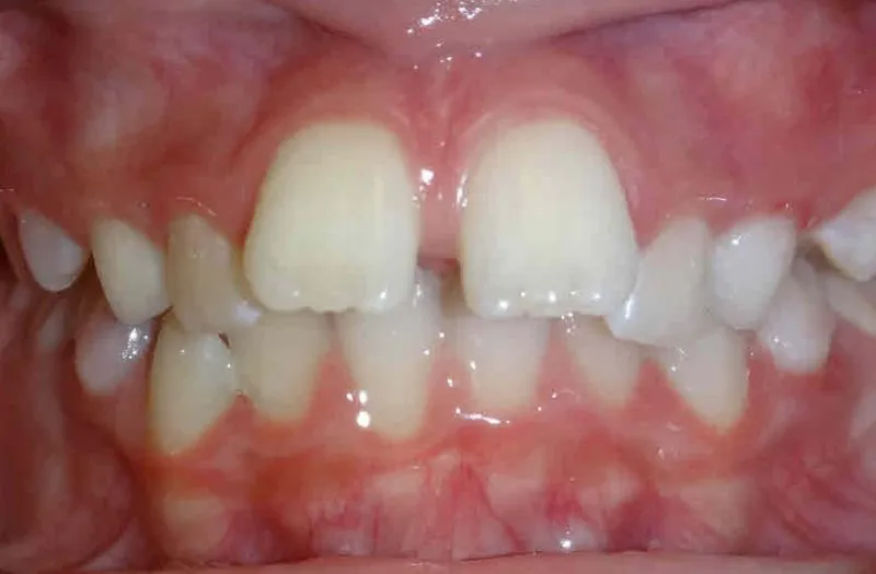 Close-up of misaligned upper and lower teeth with noticeable gaps and crowding.
