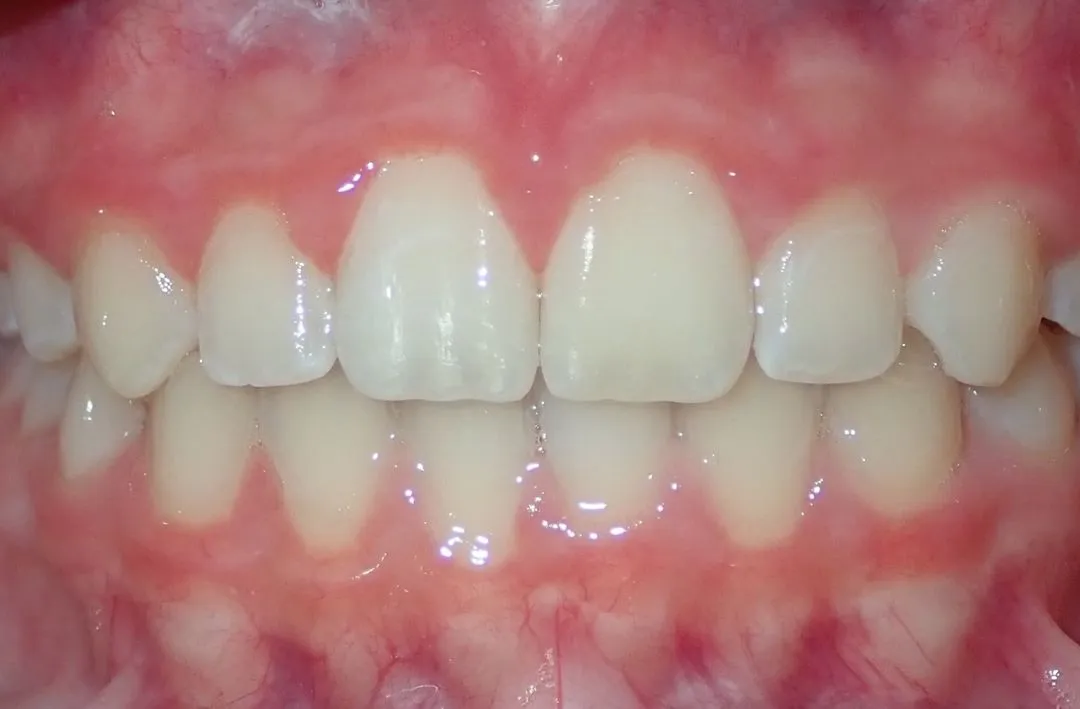 Close-up of clean, aligned upper and lower teeth and healthy pink gums.