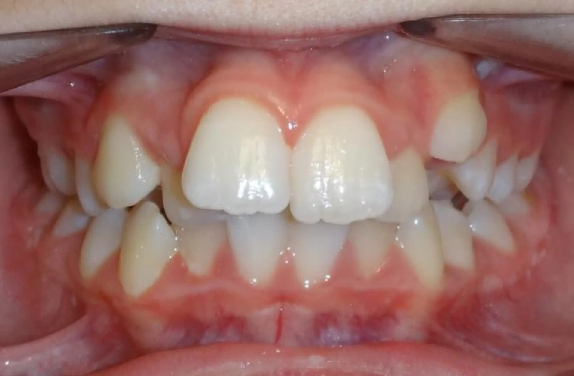 Close-up of teeth with crowded and misaligned front upper and lower teeth.