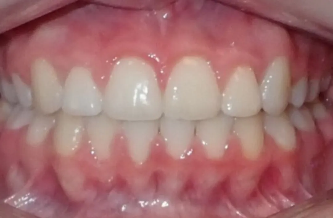 Close-up of upper and lower teeth with healthy pink gums and aligned teeth.
