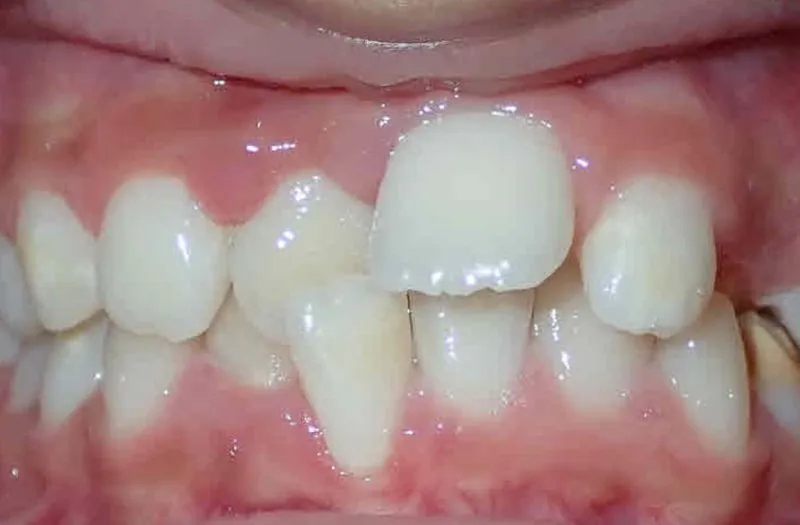 Close-up of teeth with one upper front tooth chipped and slightly misaligned lower teeth.