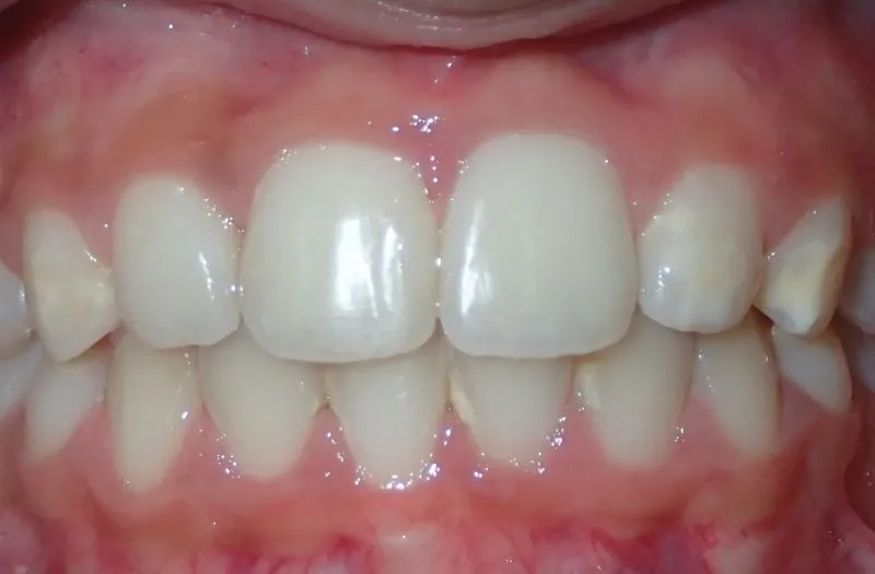 Close-up of upper and lower front teeth with slight gaps and healthy pink gums.