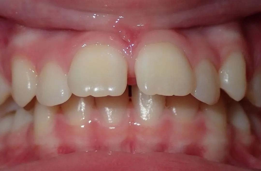 Close-up of teeth showing gaps and uneven spacing in upper and lower front teeth.