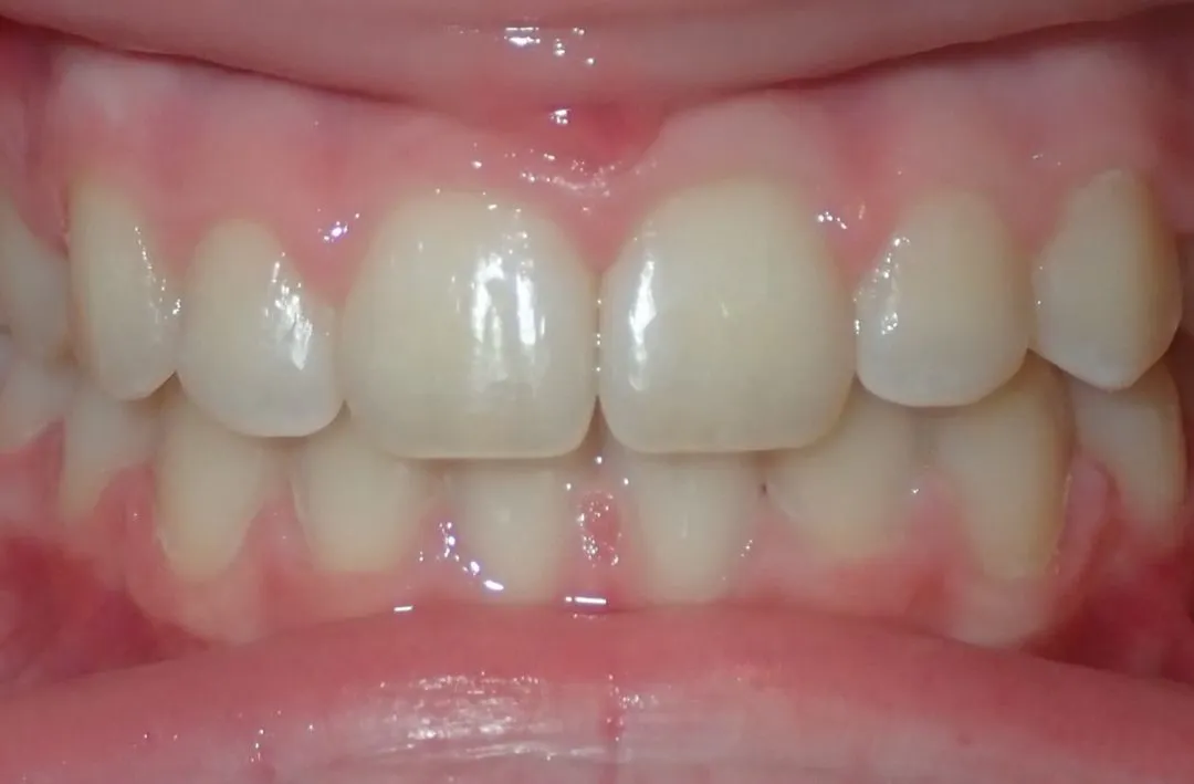 Close-up of upper and lower teeth showing a slight gap between the front upper teeth.