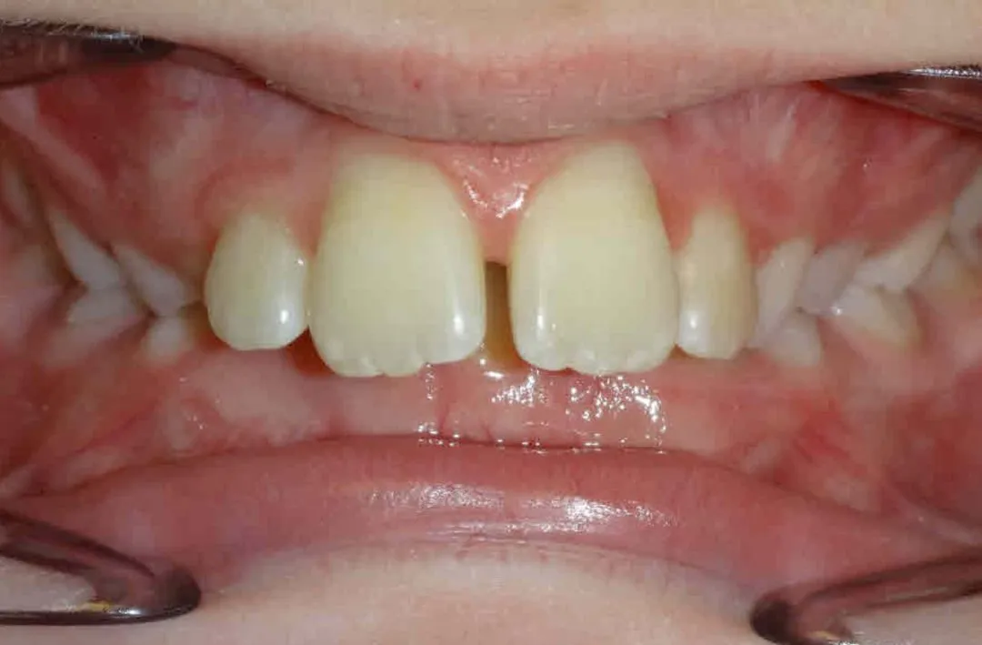 Close-up of upper front teeth with a gap and some misalignment in the mouth.