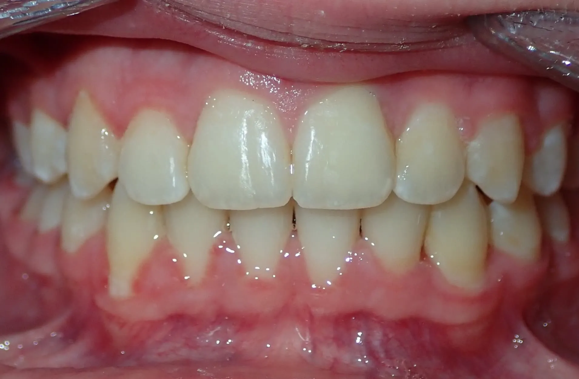 Close-up of clean, well-aligned upper and lower front teeth with healthy pink gums.