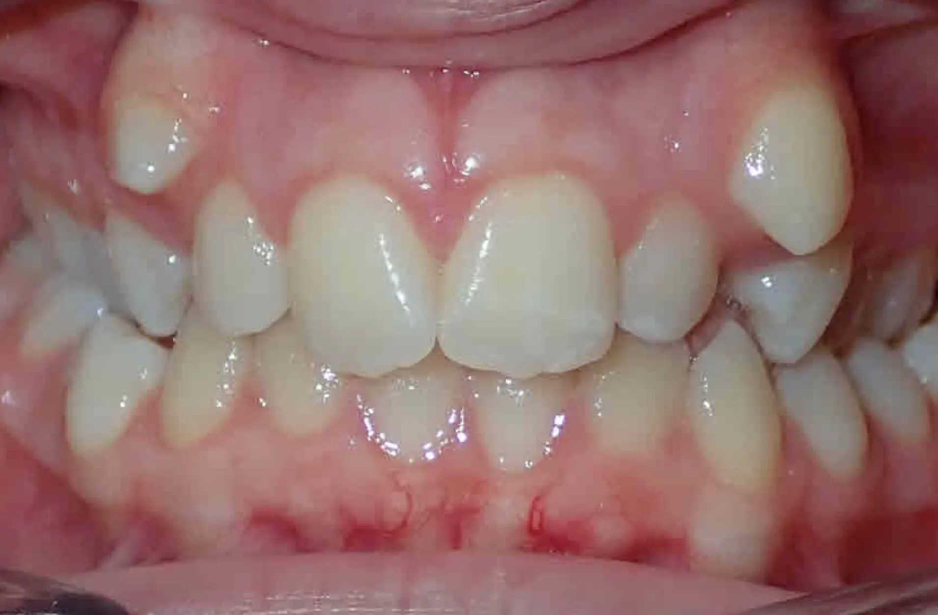 Close-up of human teeth with mild crowding and overlapping in the lower front teeth.
