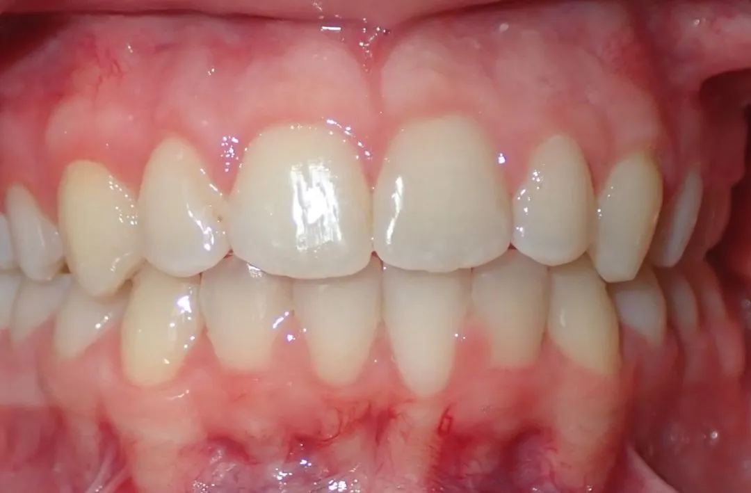 Close-up of healthy upper and lower front teeth and gums with slight pinkish color.