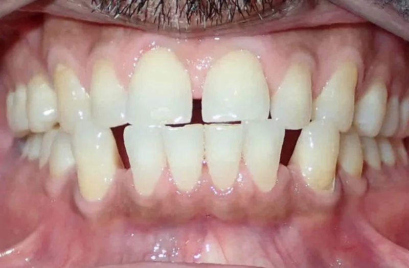 Close-up of teeth with gaps between upper front teeth and some discoloration.