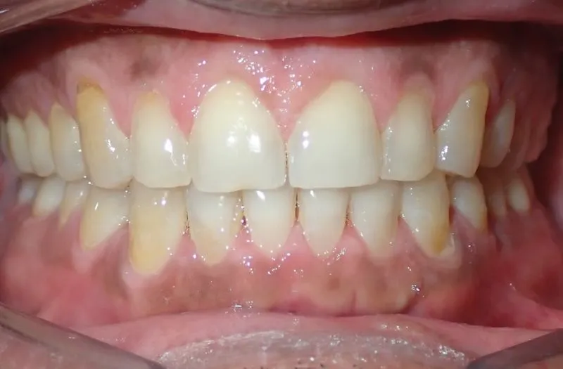 Close-up of upper and lower teeth showing mild discoloration and healthy gums.