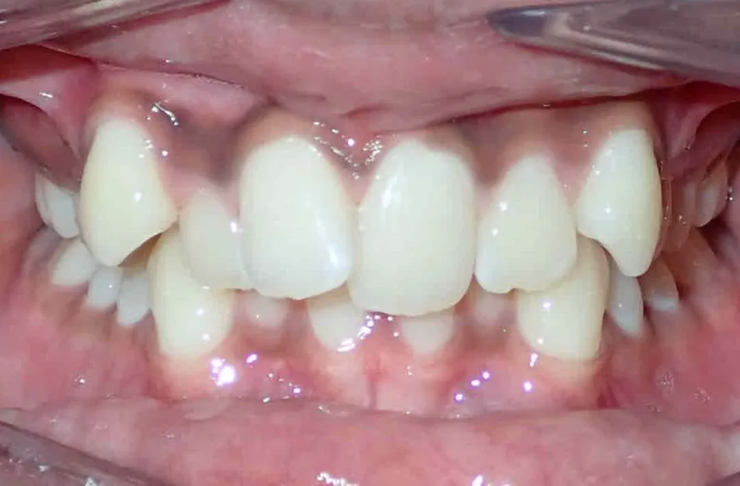 Close-up of teeth showing crowding and misalignment with overlapping and uneven spacing.
