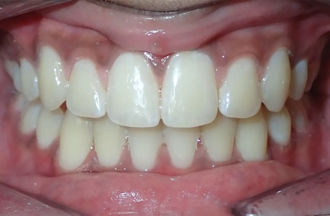 Close-up of clean, well-aligned upper and lower teeth with healthy pink gums.