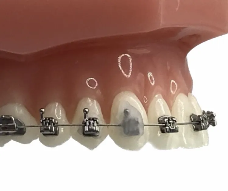 Close-up of upper teeth with metal braces and one tooth marked gray for dental treatment.