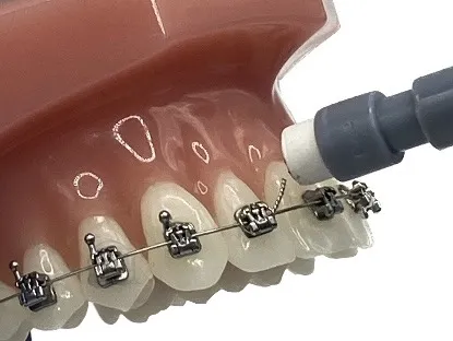 Dental model with braces and an orthodontic tool adjusting a bracket on a tooth.