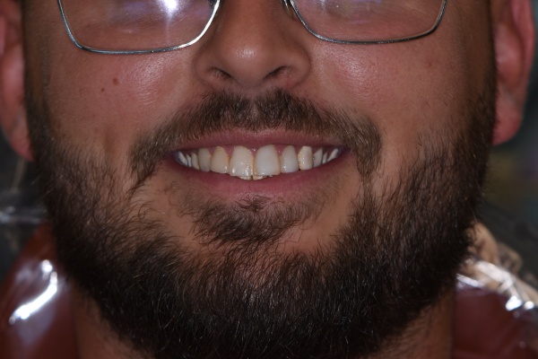 Before Image
