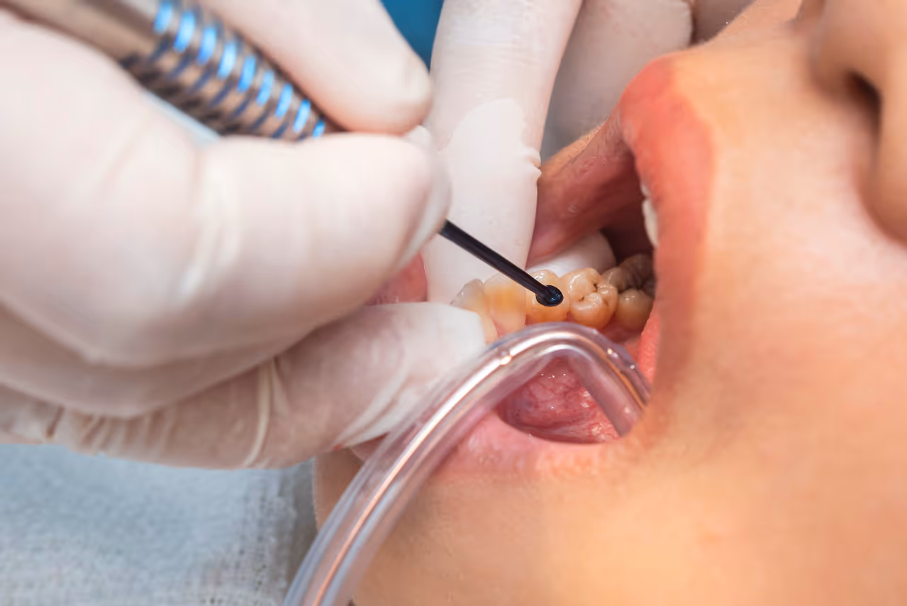 Molar Cavity Fillings: Purpose, Procedure, and Aftercare