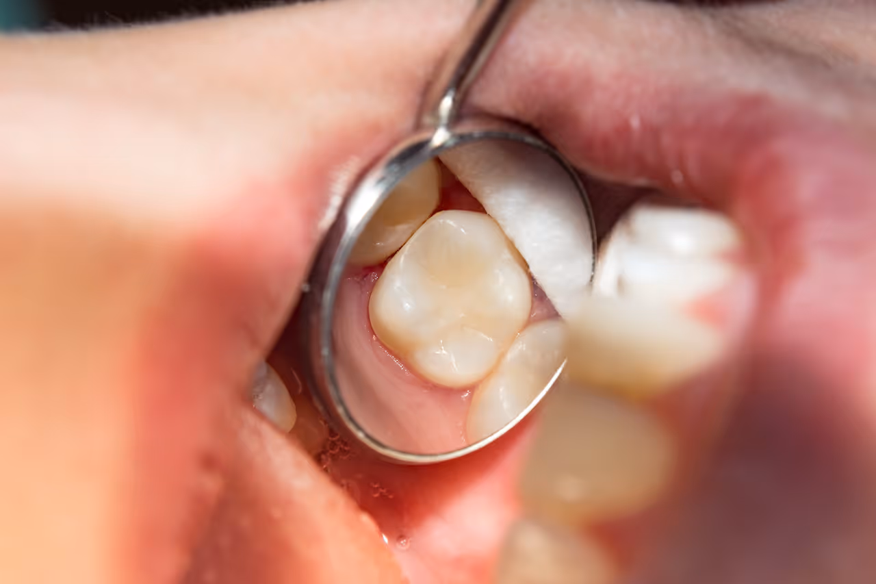 What NOT to Do After Getting Dental Fillings: Essential Aftercare Tips