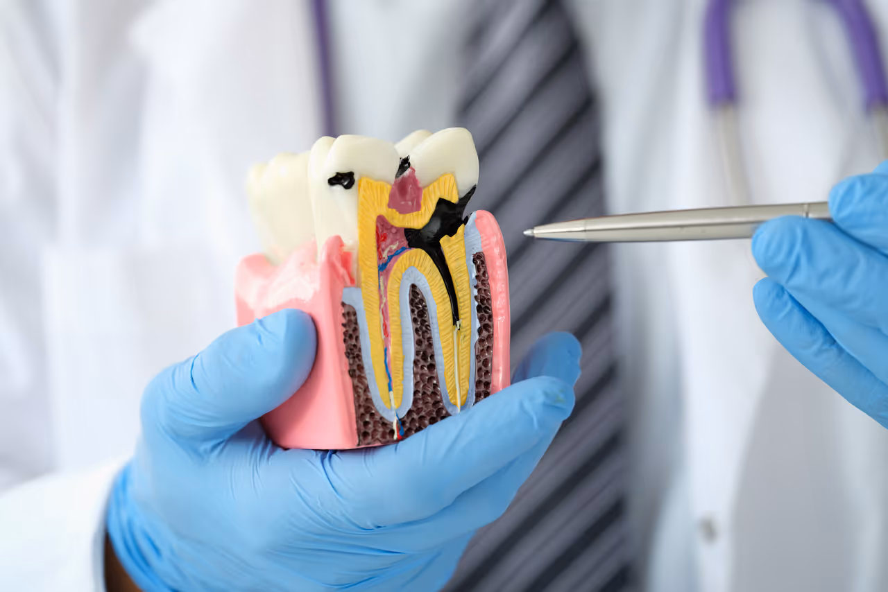 Cavity Between Teeth? How to Spot and Treat It Fast