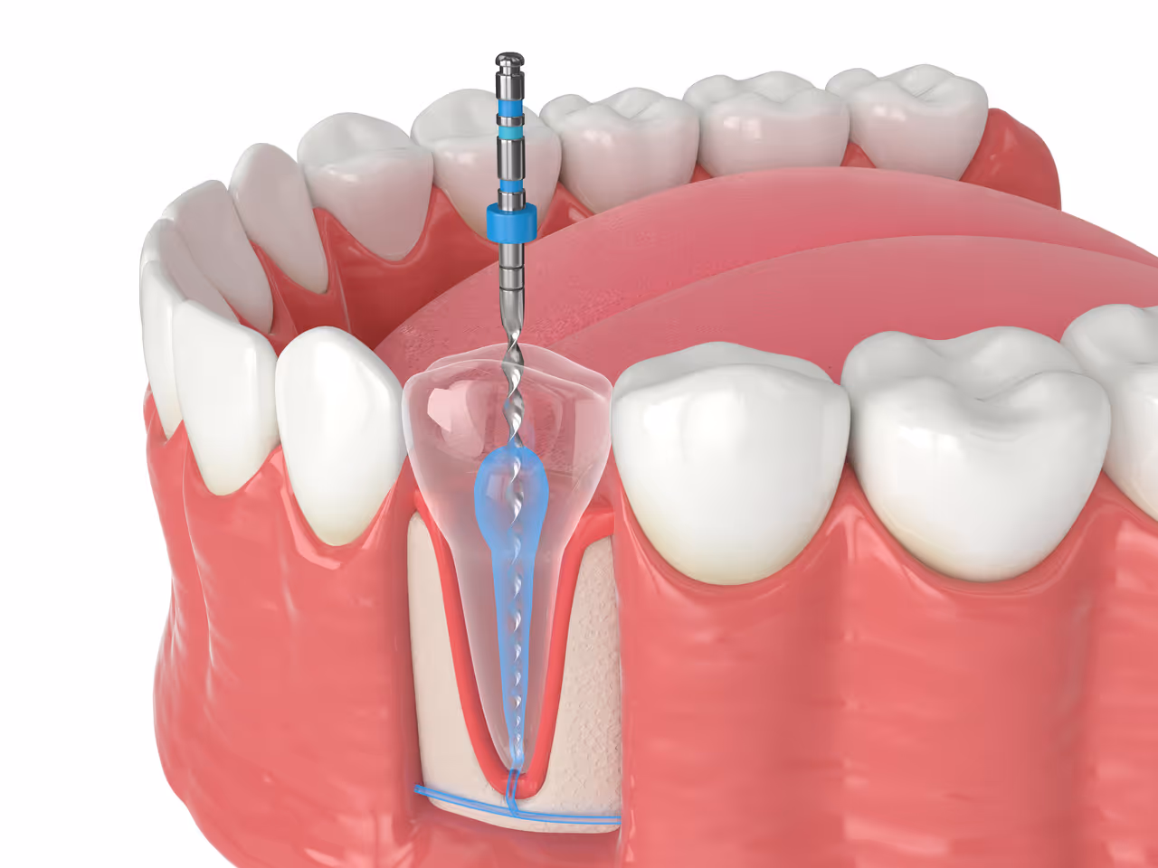 Root Canal Therapy: When and Why It’s Necessary