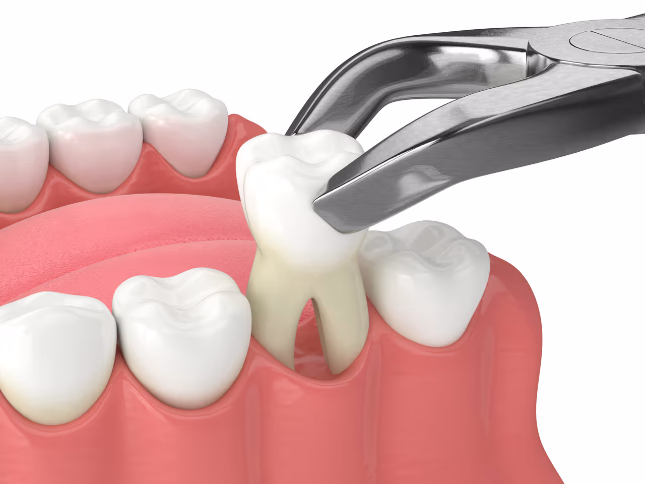Tooth Extraction Healing Stages: What You Need to Know