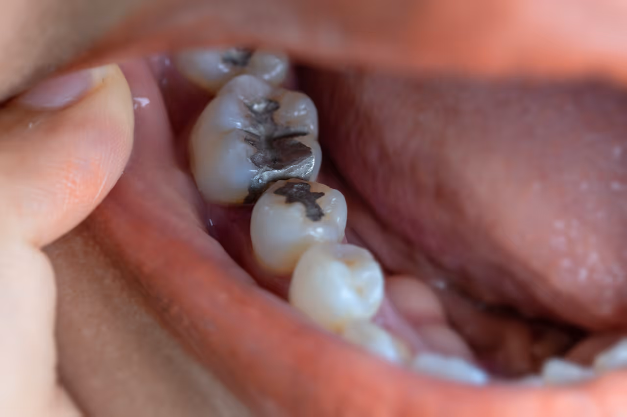 How Dental Fillings Protect Teeth From Cracks and Further Damage