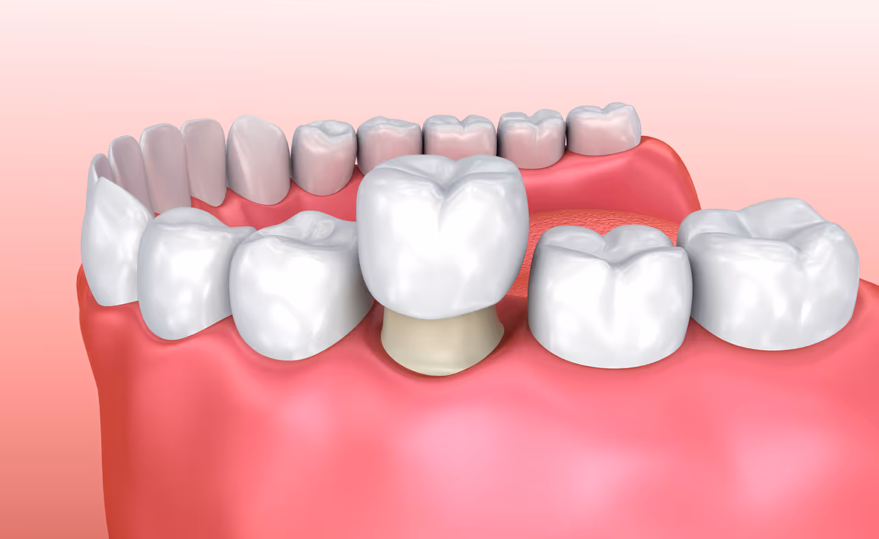 Why Dental Crowns Are Often Recommended After Root Canal Treatment