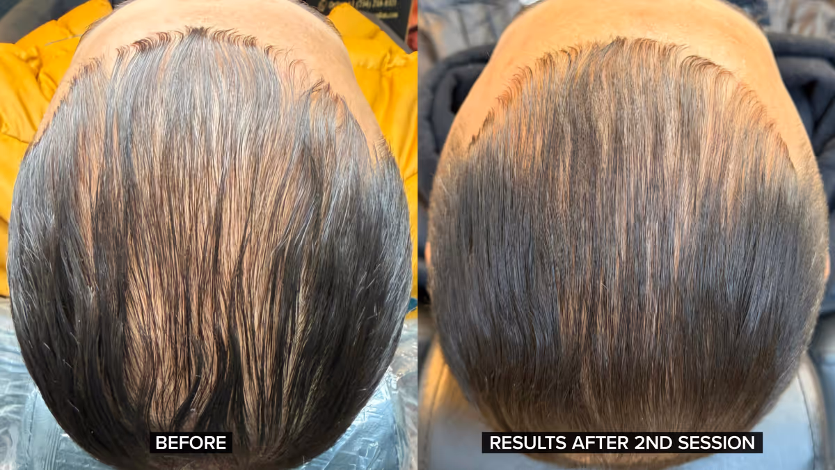 Comparison of scalp hair density before and after two hair restoration sessions.