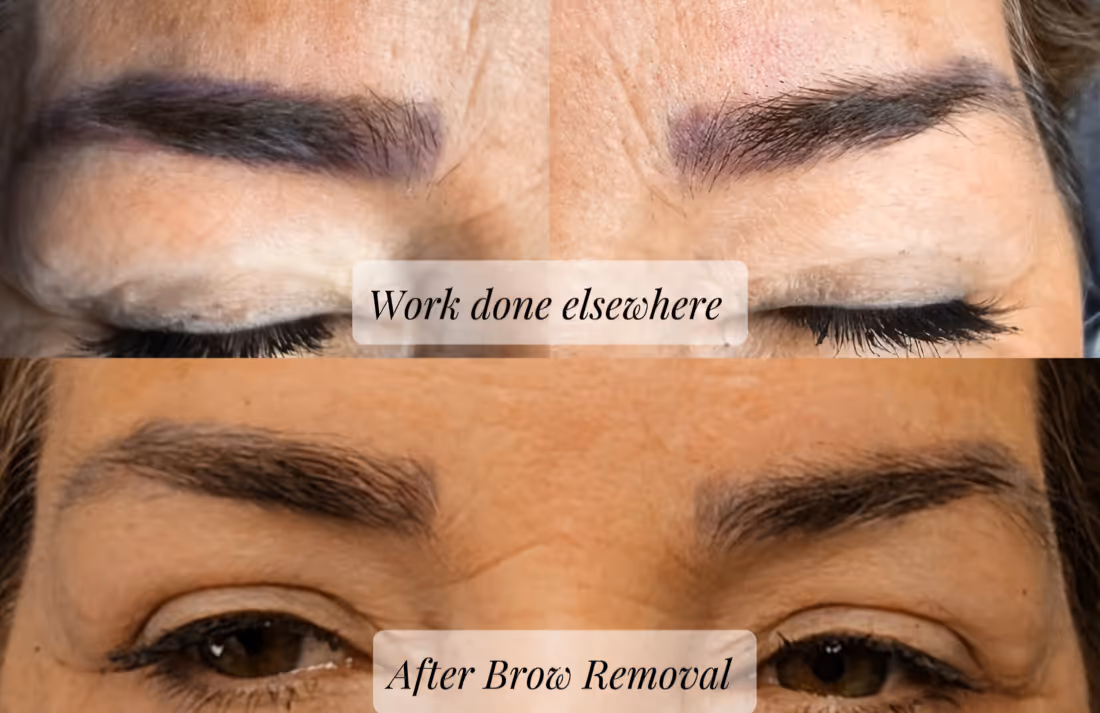 Comparison of eyebrows before and after brow removal, showing cleaner and neater eyebrows after removal.