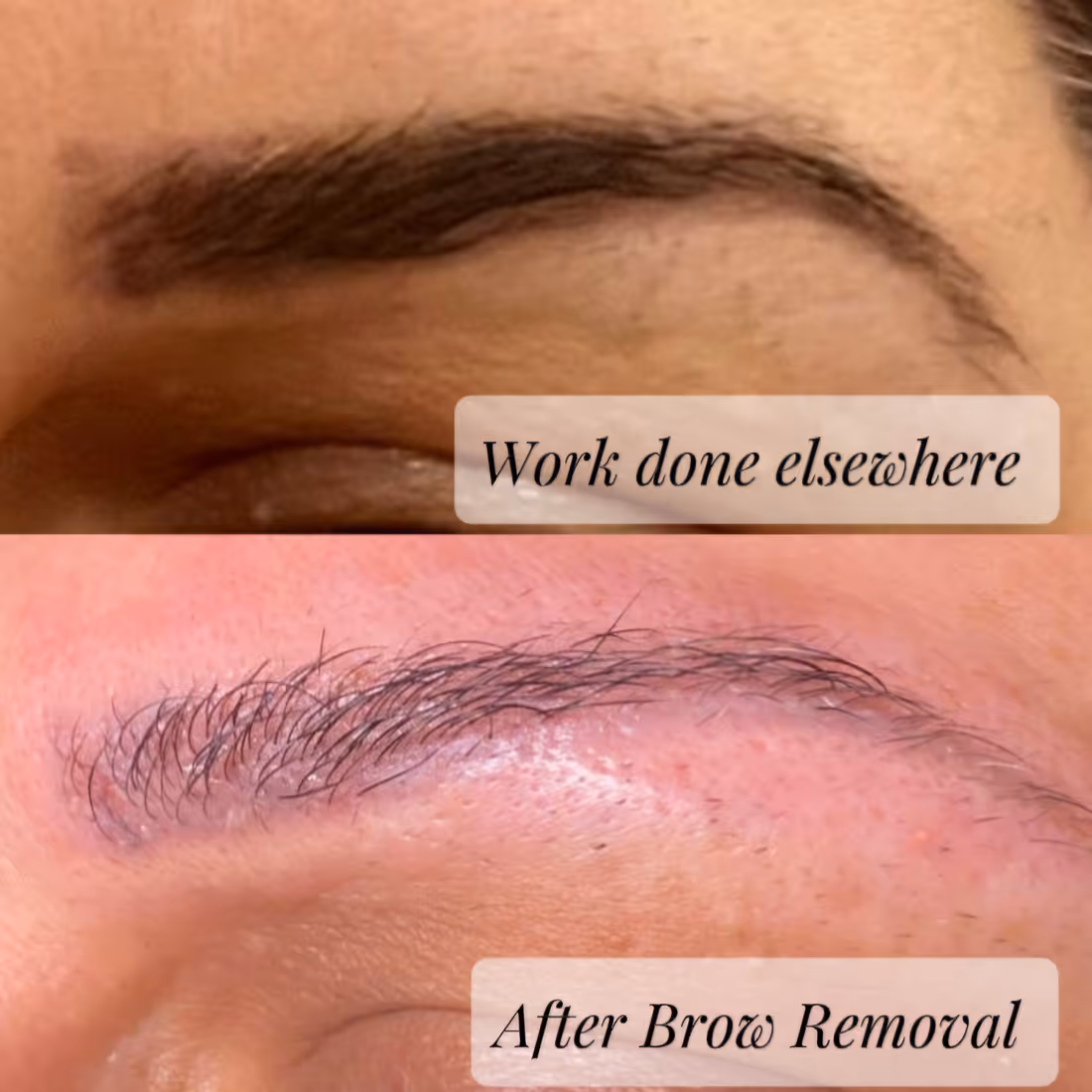 Close-up of eyebrows before and after brow removal treatment showing a cleaner, neater brow on bottom.