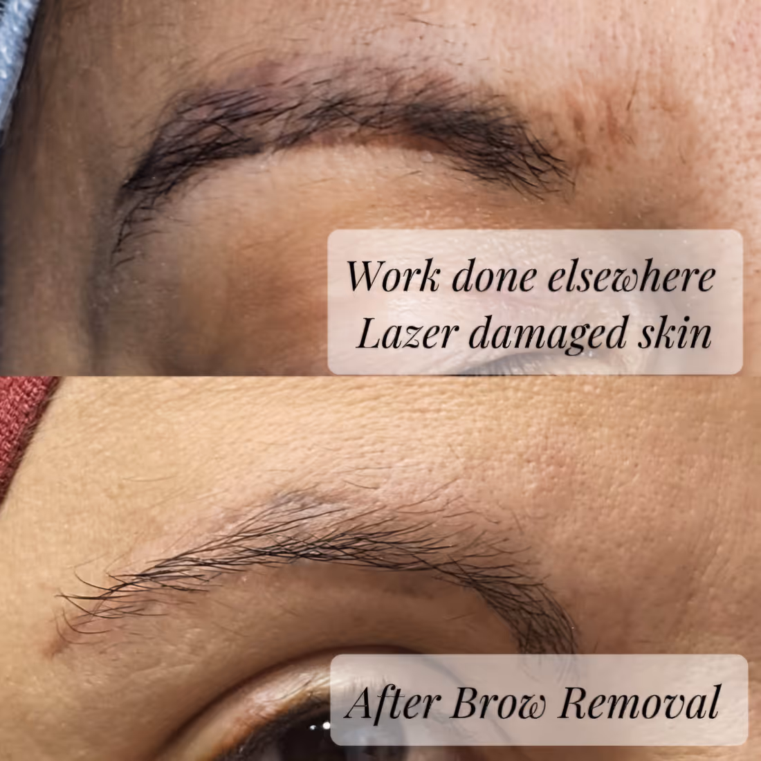 Close-up of eyebrow before with sparse hairs and skin damage; after with smooth skin and cleaner brow.