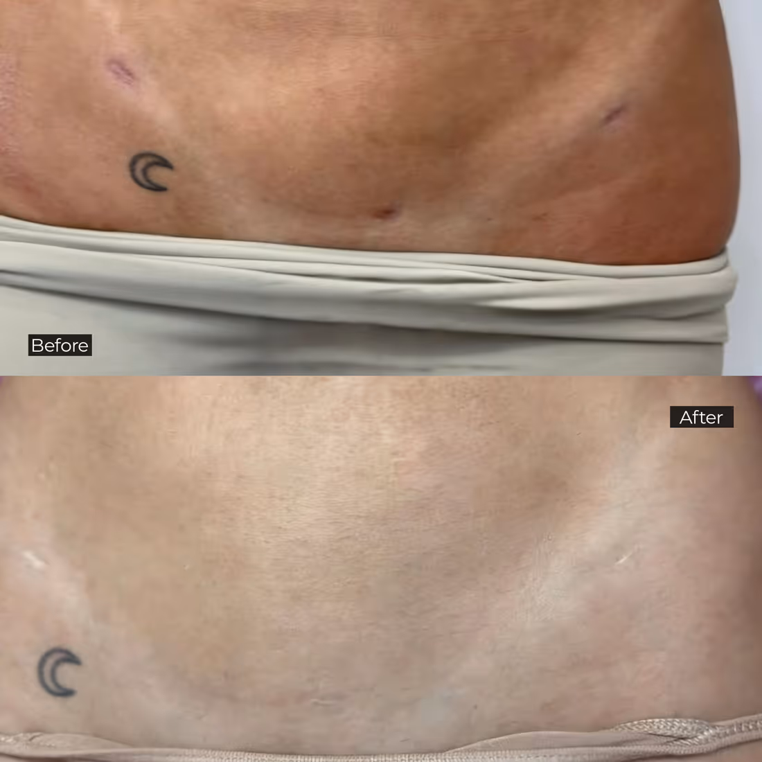 Before and after photo showing reduced scarring and smoother skin tone on lower back with crescent moon tattoo.