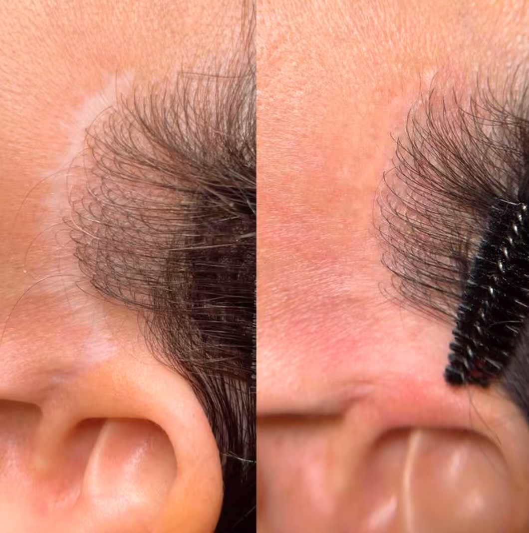 Side-by-side close-ups of an eyebrow before and after camouflage paramedical tattoo treatment.