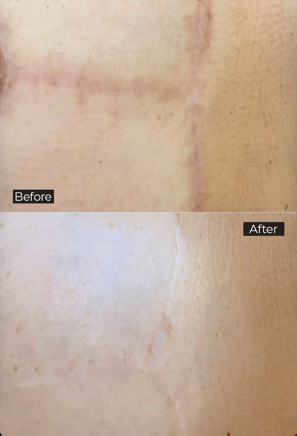 Close-up of skin showing lighter scar camouflage effect before and after treatment side by side.