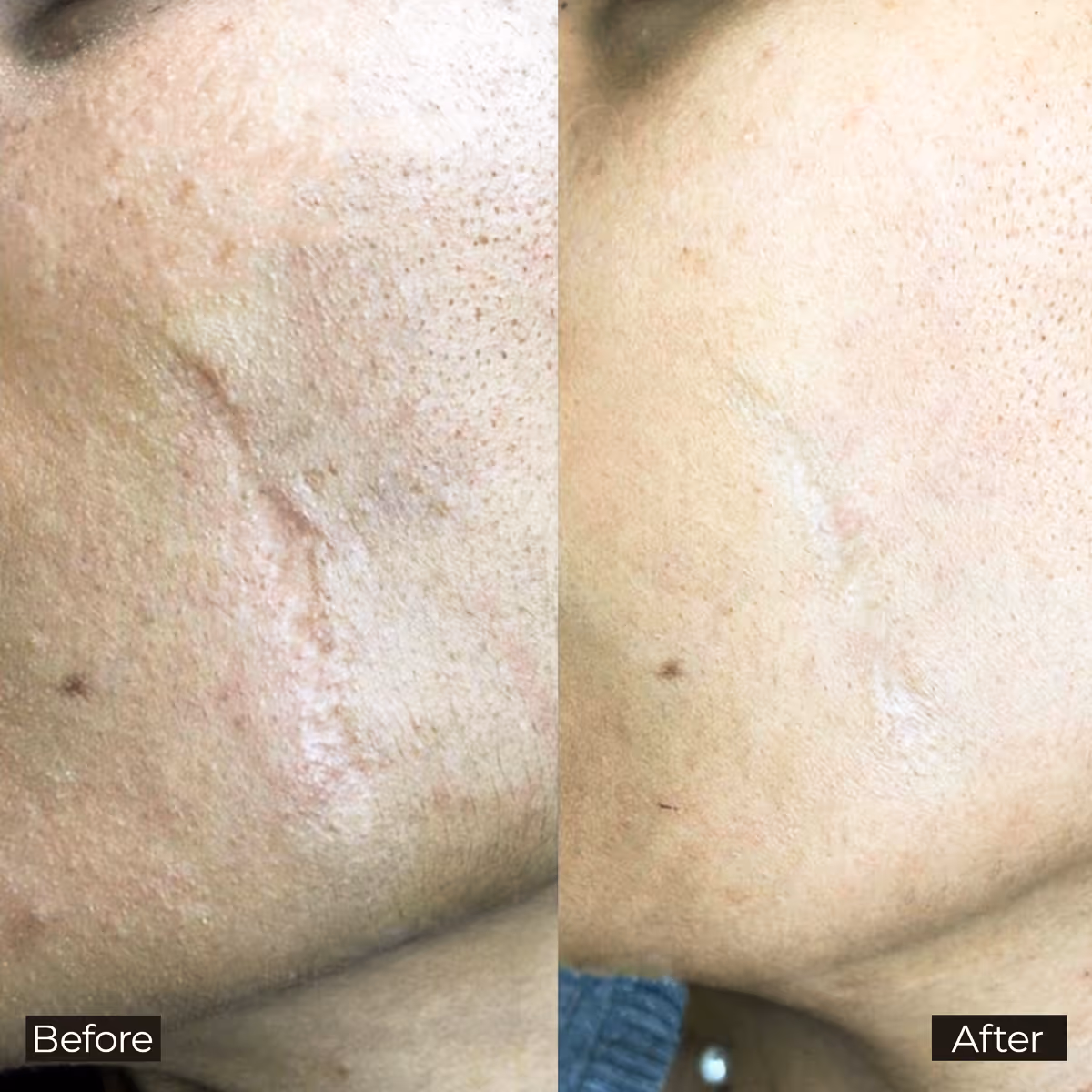 Side-by-side close-up of cheek showing scar before and after treatment with reduced visibility.
