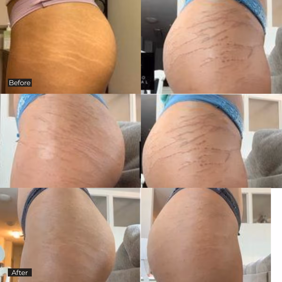 Side-by-side before and after photos showing reduced stretch marks on a person's hip and thigh area.