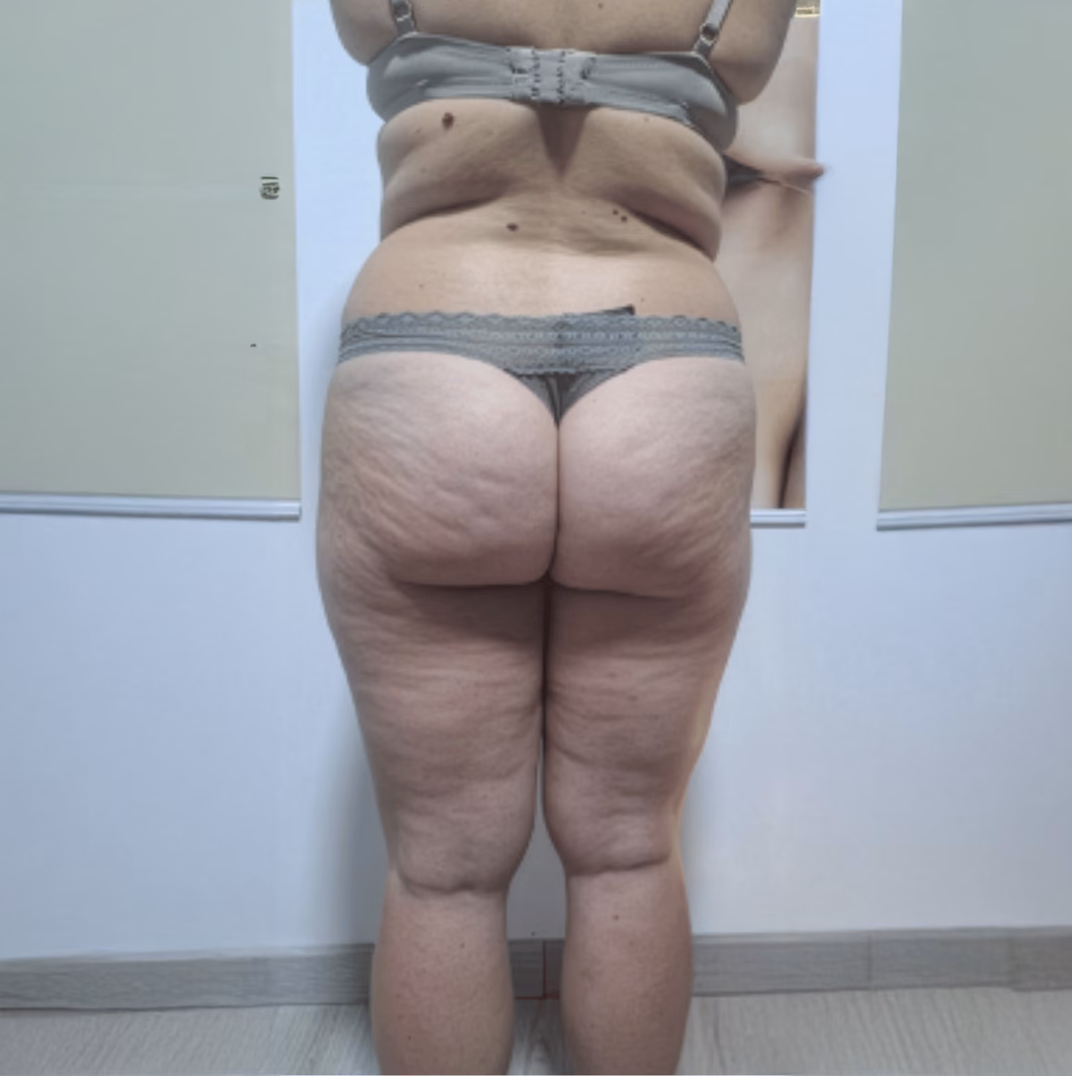 Aspect peau d’orange sur les cuisses avant la cure STARVAC
