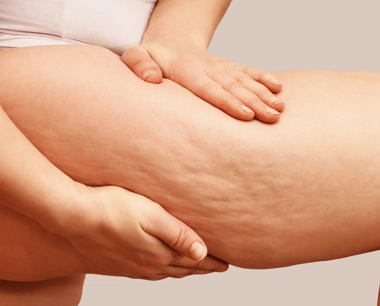 Mains pinçant une cuisse présentant de la cellulite