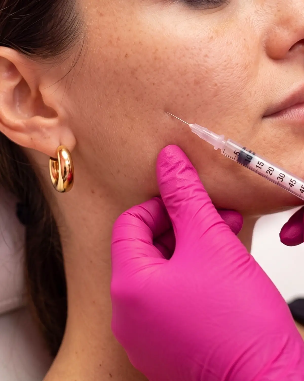 Una donna con orecchino dorato riceve un'iniezione al viso fatta da una mano con guanto rosa.