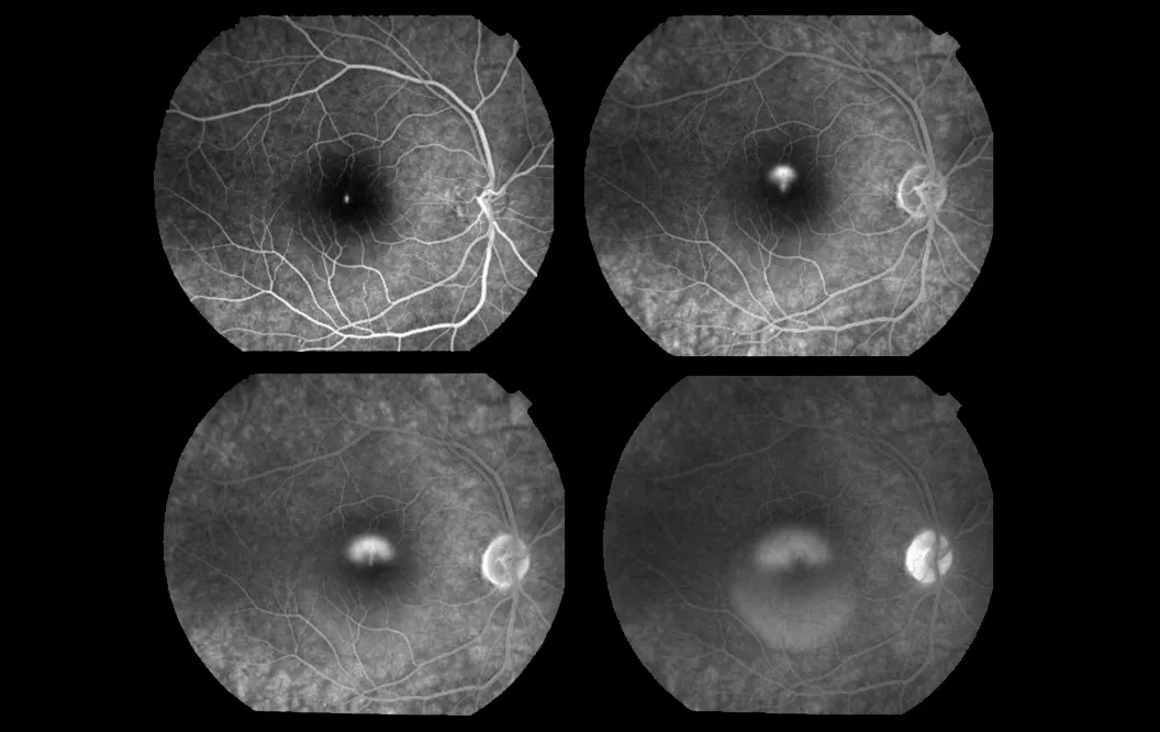 Infográfico comparativo mostrando um olho com cristalino opaco (catarata) e um olho com lente intraocular implantada recuperando a visão