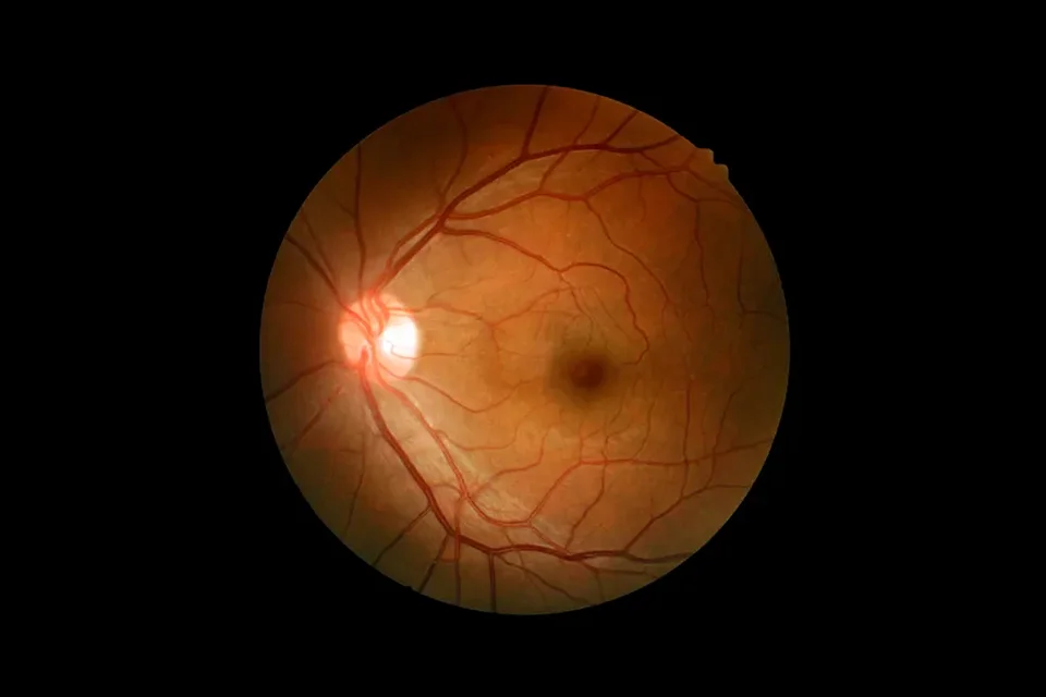 Infográfico comparativo mostrando um olho com cristalino opaco (catarata) e um olho com lente intraocular implantada recuperando a visão