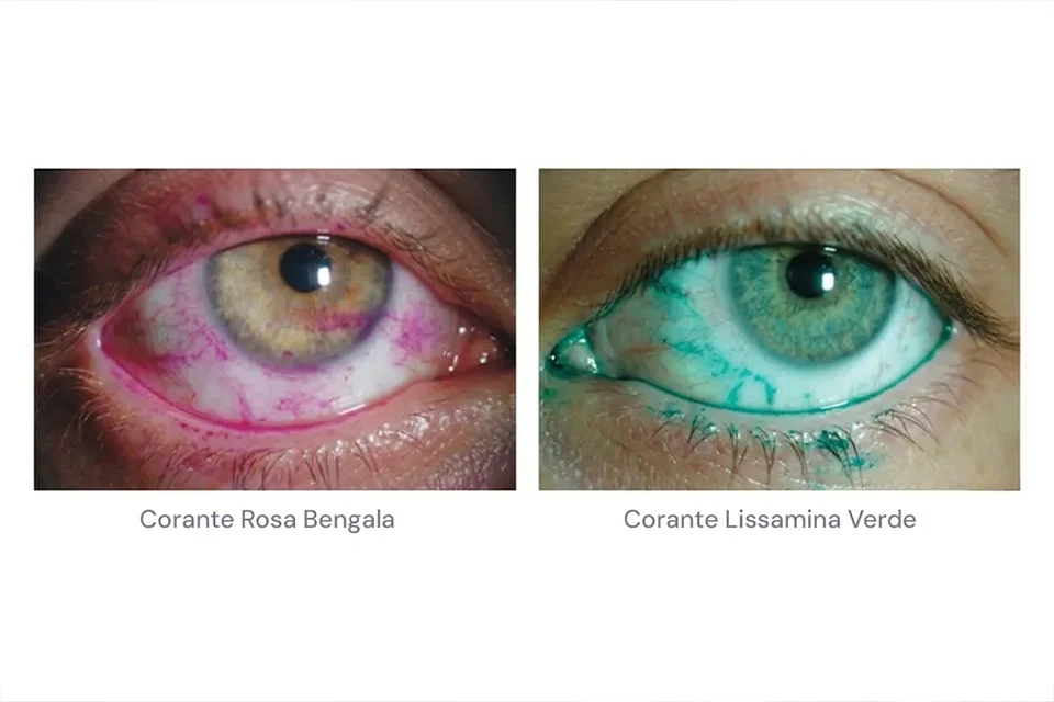 Infográfico comparativo mostrando um olho com cristalino opaco (catarata) e um olho com lente intraocular implantada recuperando a visão
