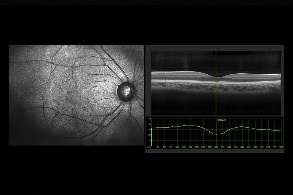 Infográfico comparativo mostrando um olho com cristalino opaco (catarata) e um olho com lente intraocular implantada recuperando a visão