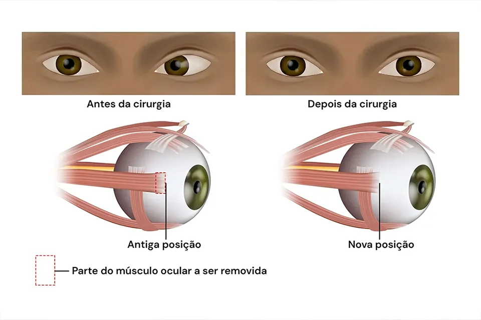 Infográfico comparativo mostrando um olho com cristalino opaco (catarata) e um olho com lente intraocular implantada recuperando a visão