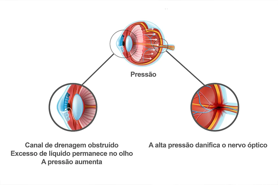 Infográfico comparativo mostrando um olho com cristalino opaco (catarata) e um olho com lente intraocular implantada recuperando a visão