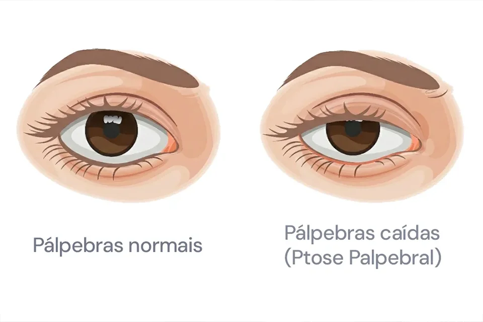 Infográfico comparativo mostrando um olho com cristalino opaco (catarata) e um olho com lente intraocular implantada recuperando a visão