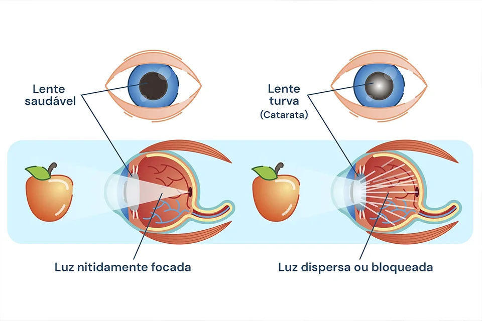 Infográfico comparativo mostrando um olho com cristalino opaco (catarata) e um olho com lente intraocular implantada recuperando a visão