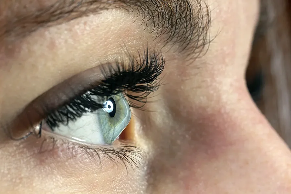 Infográfico comparativo mostrando um olho com cristalino opaco (catarata) e um olho com lente intraocular implantada recuperando a visão