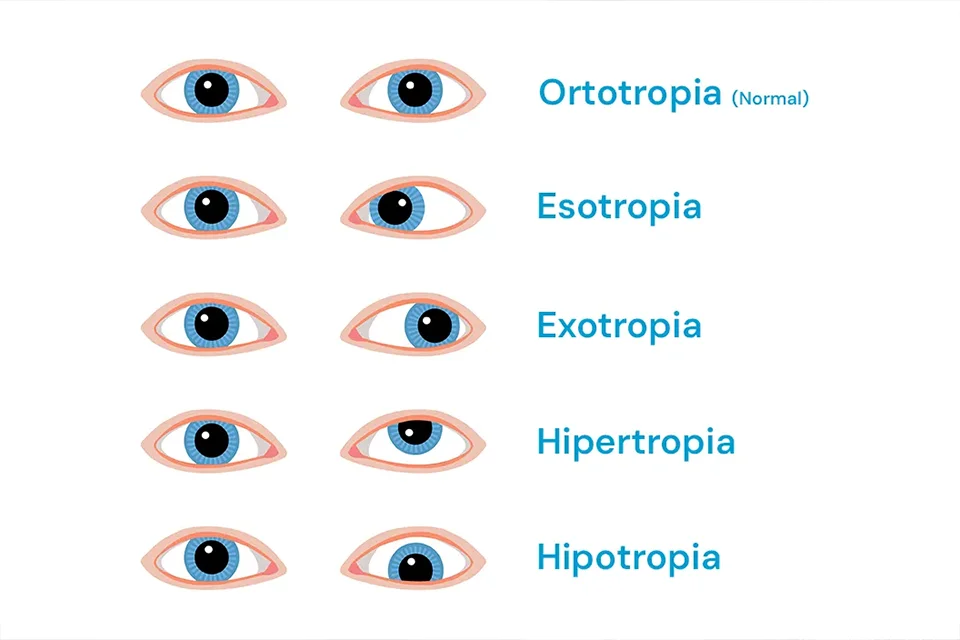 Infográfico comparativo mostrando um olho com cristalino opaco (catarata) e um olho com lente intraocular implantada recuperando a visão