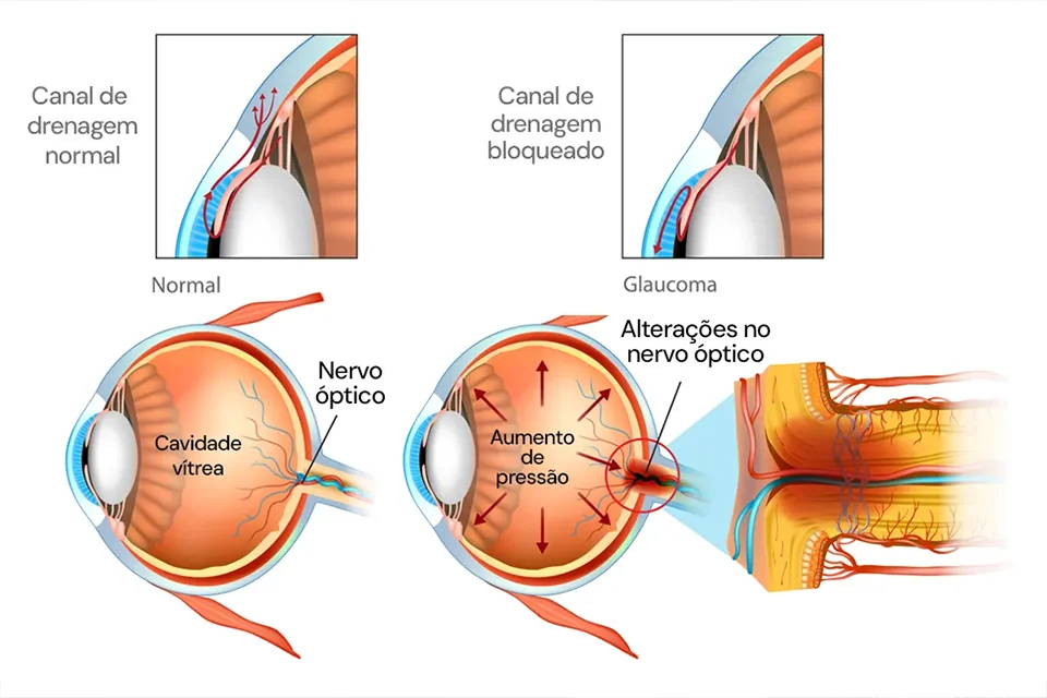 Infográfico comparativo mostrando um olho com cristalino opaco (catarata) e um olho com lente intraocular implantada recuperando a visão