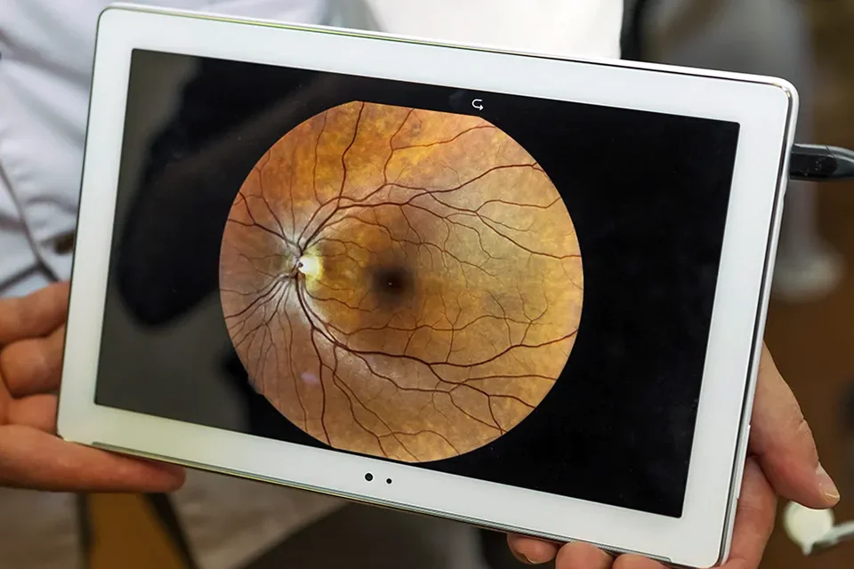 Infográfico comparativo mostrando um olho com cristalino opaco (catarata) e um olho com lente intraocular implantada recuperando a visão